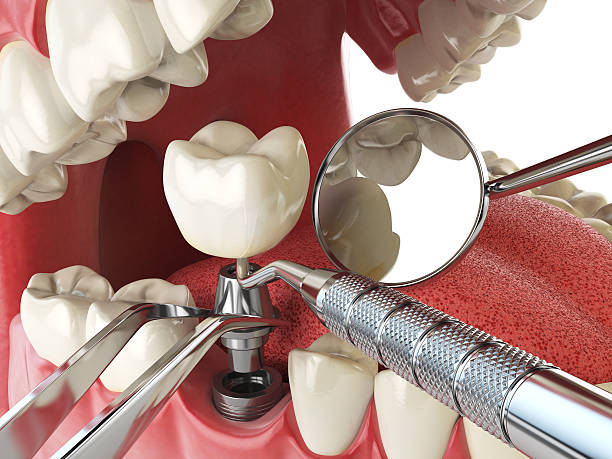 Best Urgent Care for Lost Fillings or Crowns in Intercourse, PA